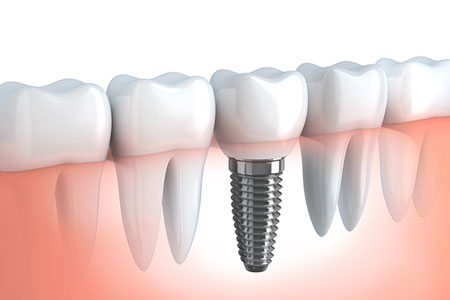 Dental Implants