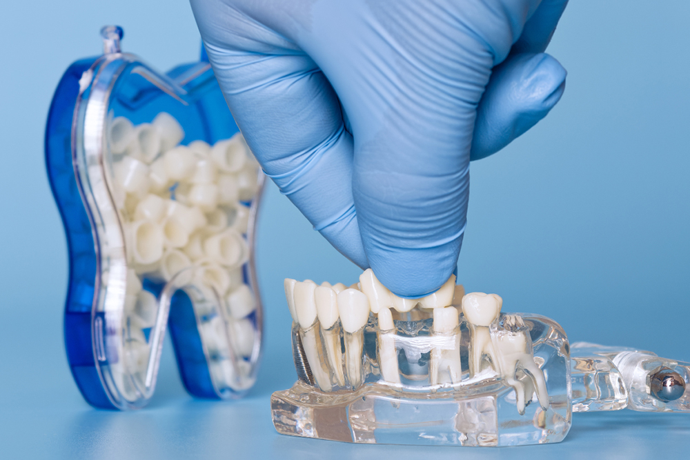 Dental crowns & bridges comparison with implants at St. Jacobs Dental Care